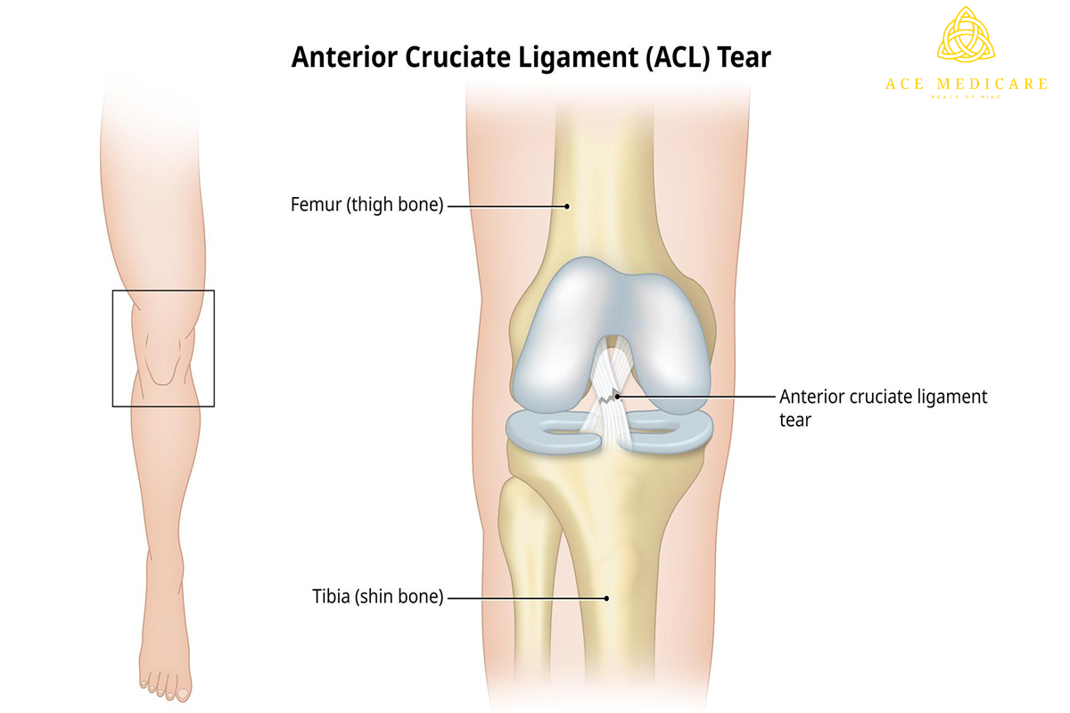 The Basics of ACL Reconstruction Surgery: A Comprehensive Guide